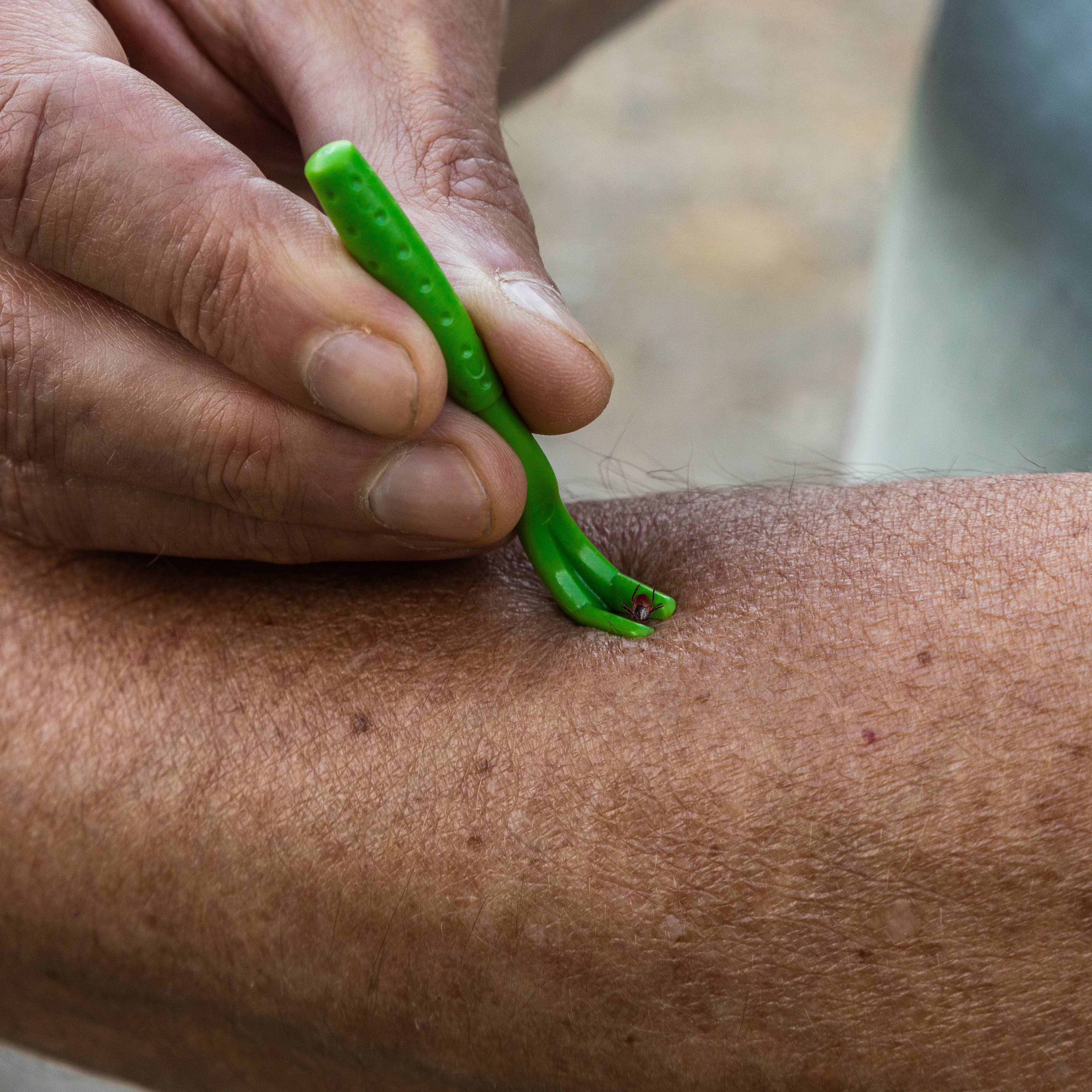 removing tick from arm